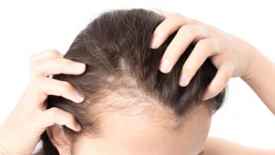 female-pattern-baldness-in-woman-s-scalp